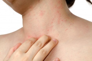 What Is Eczema & What Are The Causes Of It?
